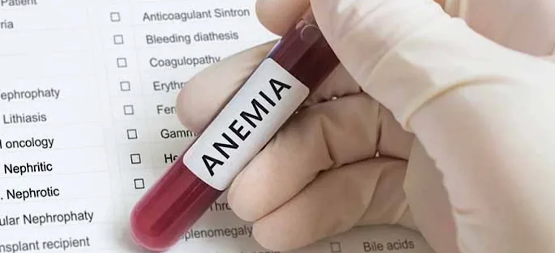 Anemia. How to overcome it?